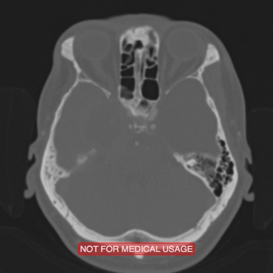 File:Nasopharyngeal carcinoma recurrence - skull base destruction (Radiopaedia 29107-29490 Axial bone window 75).jpg
