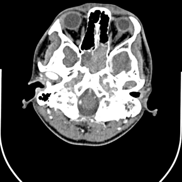 File:Nasopharyngeal carcinoma with skull base invasion (Radiopaedia 53415-59705 A 22).jpg