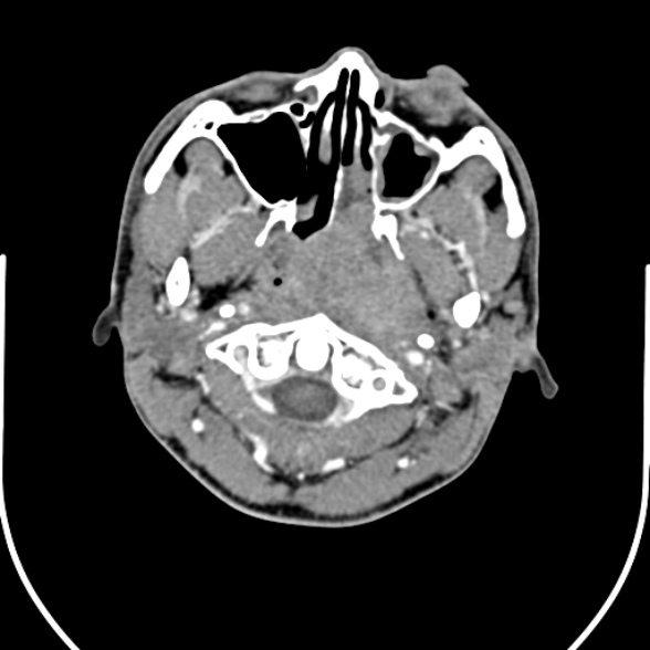 Nasopharyngeal carcinoma with skull base invasion (Radiopaedia 53415-59705 A 46).jpg