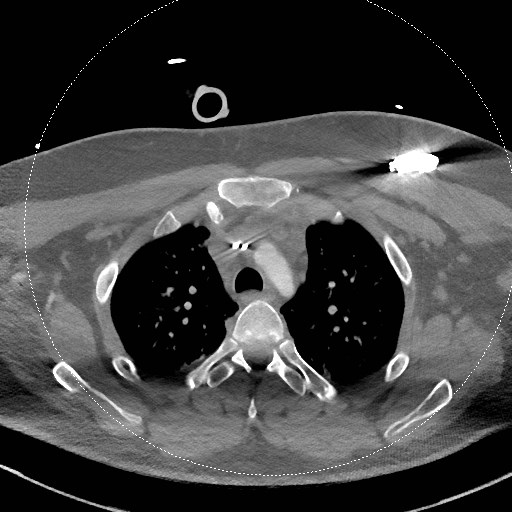 Neck CT angiogram (intraosseous vascular access) (Radiopaedia 55481-61945 B 61).jpg