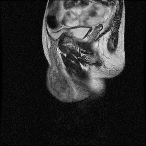 File:Necrotizing epididymo-orchitis with intra-testicular abscess (Radiopaedia 29397-29860 Sagittal T2 15).jpg
