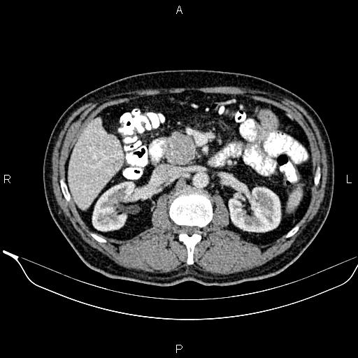 Necrotizing pancreatitis (Radiopaedia 87796-104249 A 23).jpg