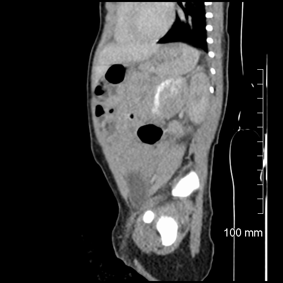 File:Neonatal neuroblastoma (Radiopaedia 56651-63438 C 35).jpg