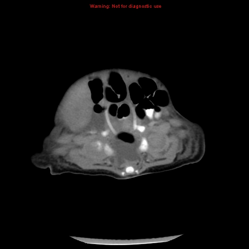 File:Neonatal neuroblastoma (Radiopaedia 9564-10223 A 42).jpg