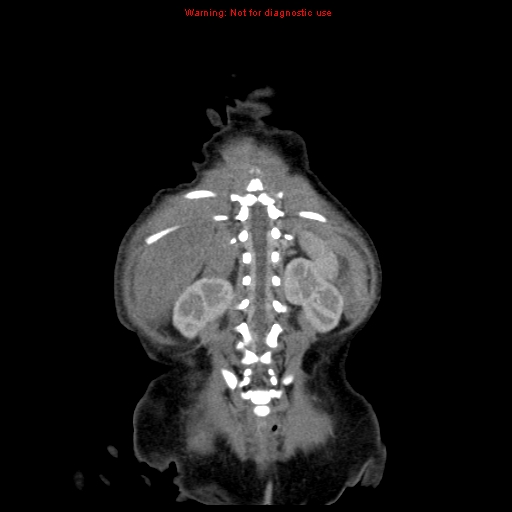 File:Neonatal neuroblastoma (Radiopaedia 9564-10223 B 101).jpg