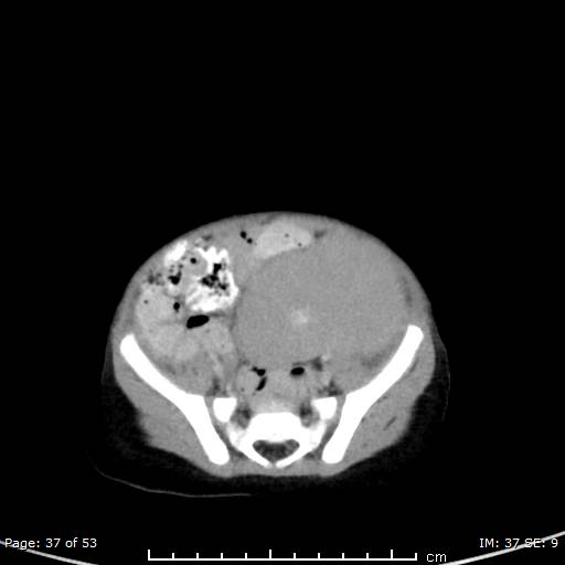 Nephroblastomatosis (Radiopaedia 41934-44935 A 37).jpg