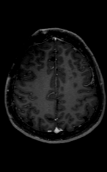 Neuro-Behçet disease (Radiopaedia 90112-107294 Axial T1 C+ 87).jpg