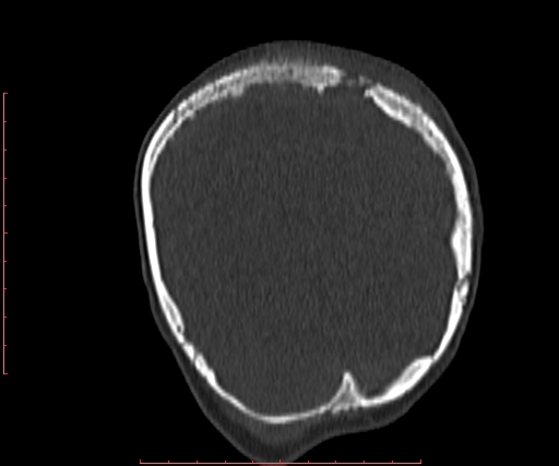 File:Neuroblastoma skull metastasis (Radiopaedia 56053-62683 Coronal bone window 37).jpg