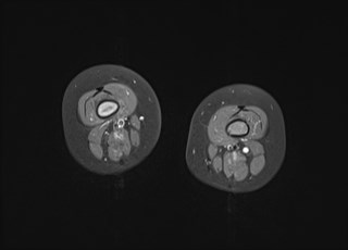 File:Neuroblastoma with bone metastases (Radiopaedia 67080-76414 Axial T1 C+ fat sat 18).jpg
