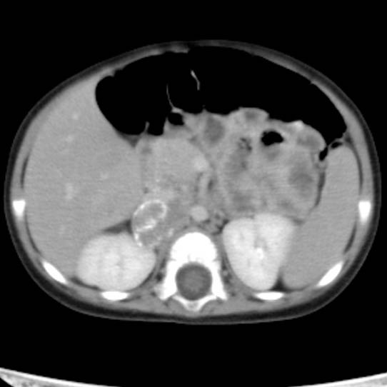 Neuroblastoma with skull metastases (Radiopaedia 30326-30960 C 21).jpg