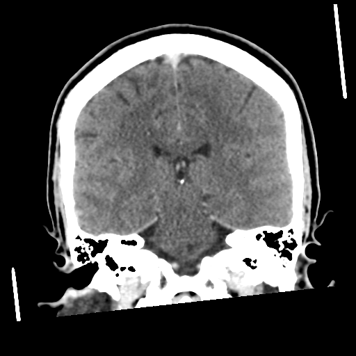 Neurocysticercosis - granular nodular (Radiopaedia 42786-45957 Coronal C+ 39).png