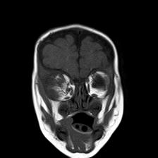 File:Neurofibromatosis type 1 (Radiopaedia 30089-30671 Coronal T1 6).jpg