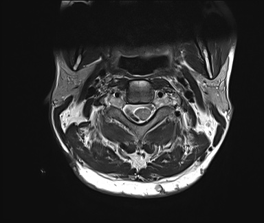 File:Neurofibromatosis type 1 (Radiopaedia 80355-93740 Axial T2 8).jpg
