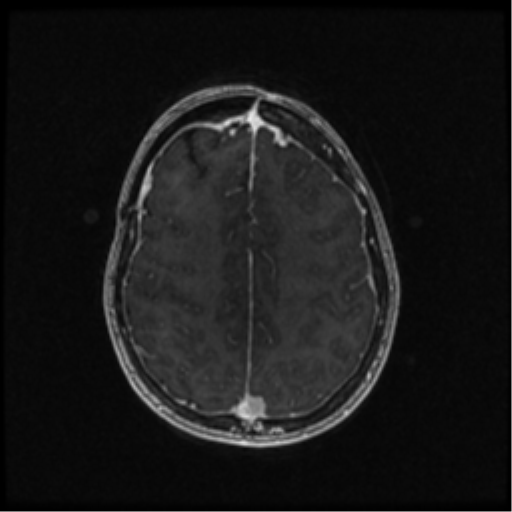 Neurofibromatosis type 2 (Radiopaedia 45229-49244 Axial T1 C+ 85).png