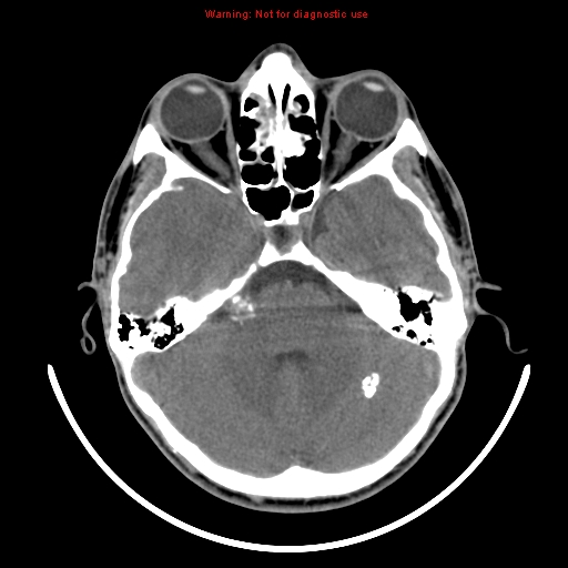 File:Neurofibromatosis type 2 (Radiopaedia 8953-9732 Axial non-contrast 10).jpg