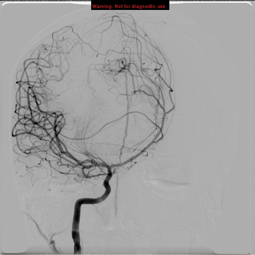 File:Neurofibromatosis type 2 (Radiopaedia 8953-9733 D 6).jpg