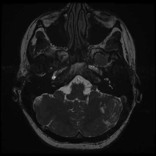 Neurofibromatosis type 2 - bilateral acoustic neuromata (Radiopaedia 40060-42566 Axial FIESTA 25).png