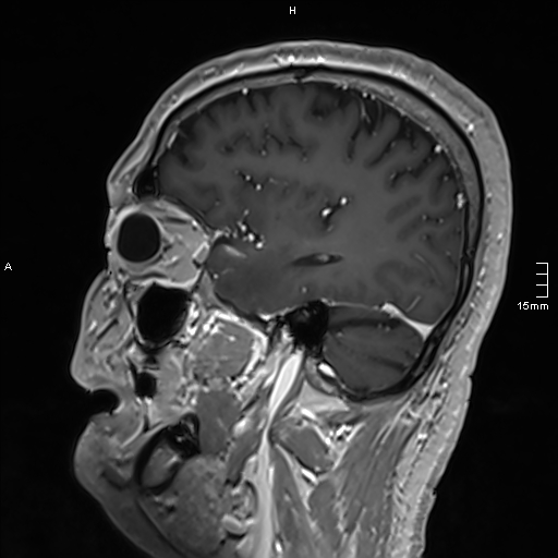Neurosarcoidosis - involvement of the mesial temporal lobes (Radiopaedia 67429-76820 Sagittal T1 C+ 50).jpg