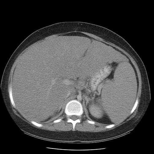 File:Non-Hodgkin lymphoma involving pelvis (Radiopaedia 21281-21197 A 22).jpg