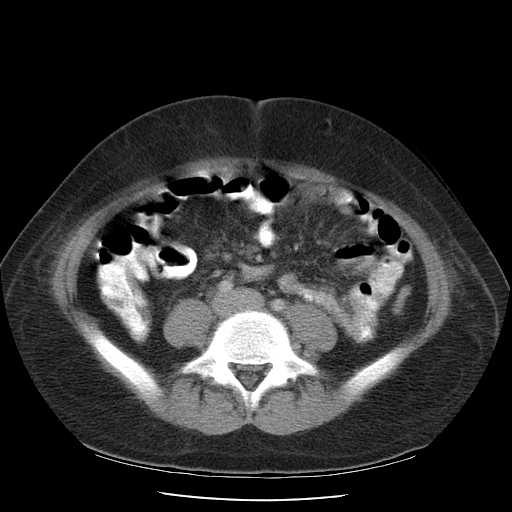 File:Non-Hodgkin lymphoma involving pelvis (Radiopaedia 21281-21197 A 41).jpg