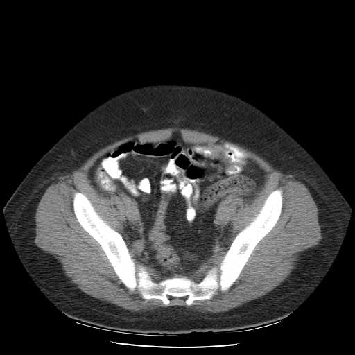 File:Non-Hodgkin lymphoma involving pelvis (Radiopaedia 21281-21197 B 51).jpg