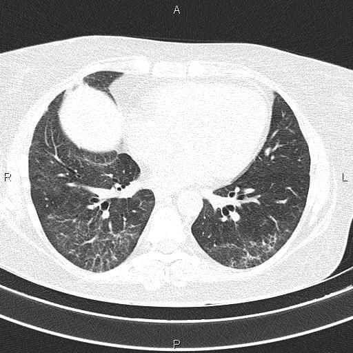 Non-specific interstitial pneumonia (Radiopaedia 83185-97567 Axial lung window 41).jpg