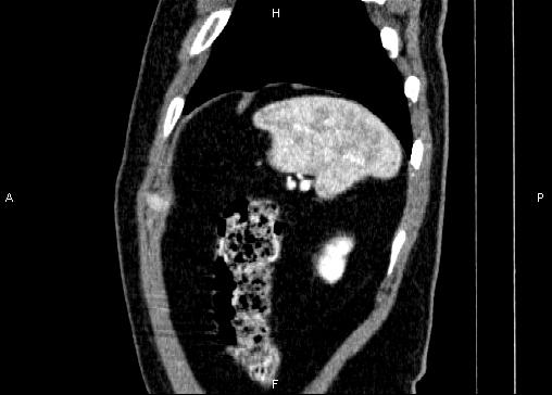 Non-syndromic pancreatic endocrine tumor (Radiopaedia 86958-103178 E 90).jpg