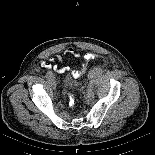 File:Non Hodgkin lymphoma in a patient with ankylosing spondylitis (Radiopaedia 84323-99621 Axial non-contrast 54).jpg