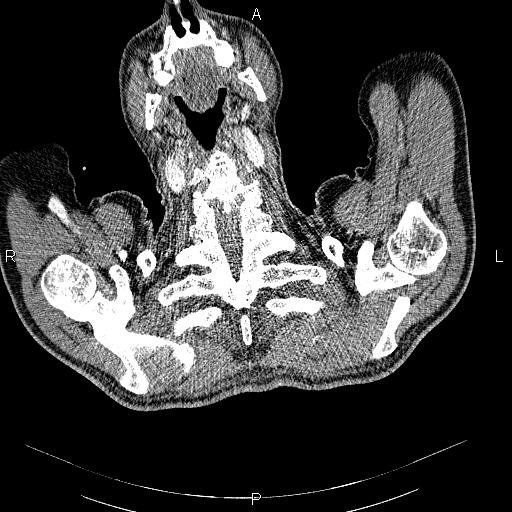 File:Non Hodgkin lymphoma in a patient with ankylosing spondylitis (Radiopaedia 84323-99621 B 2).jpg