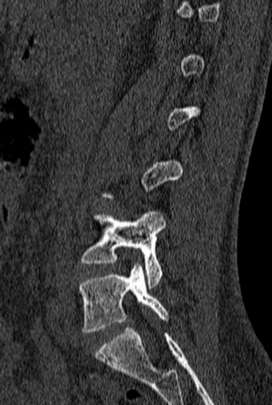 File:Normal CT lumbar spine (Radiopaedia 53981-60118 Sagittal bone window 31).jpg