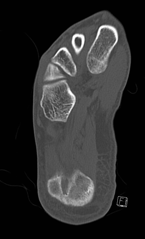 Normal CT of the ankle (Radiopaedia 47111-51658 Axial bone window 83).jpg