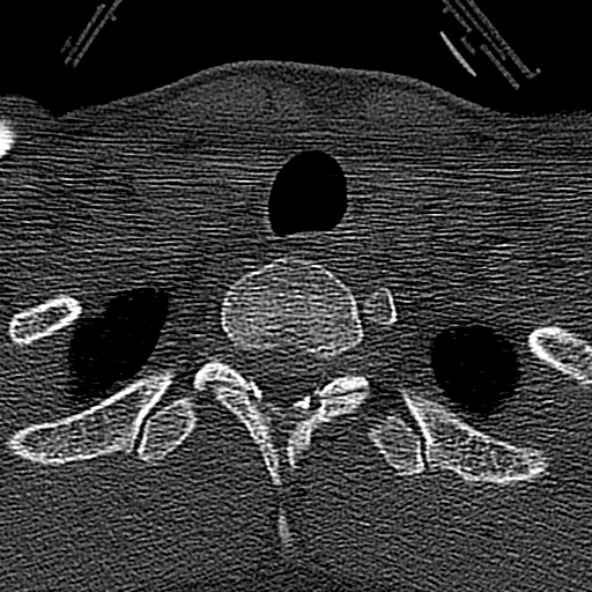 Normal CT of the cervical spine (Radiopaedia 53322-59305 Axial bone window 244).jpg