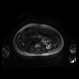 Normal MRI abdomen in pregnancy (Radiopaedia 88001-104541 Axial DWI 68).jpg