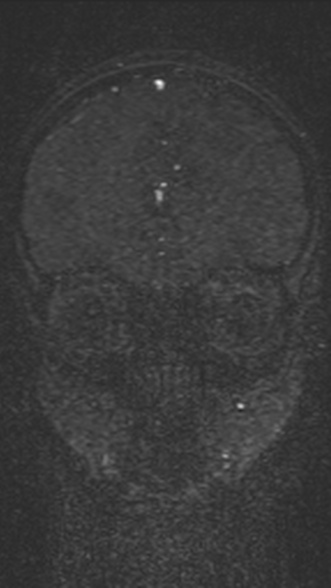 Normal MRI brain with MRV- teenager (Radiopaedia 49425-54553 Coronal MRV 73).jpg