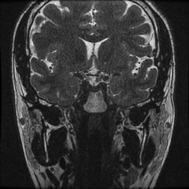 Normal MRI petrous (Radiopaedia 91317-108949 Coronal T2 1).jpg