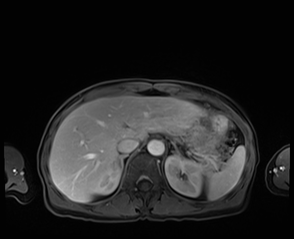 Normal adrenal glands MRI (Radiopaedia 82017-96004 K 22).jpg