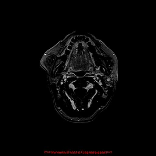 Normal adult brain MRI (non-enhanced and contrast-enhanced) (Radiopaedia 75262-86379 Axial T1 C+ 9).jpg