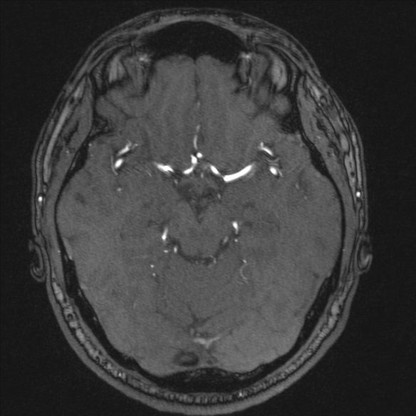 Normal brain MRI including MRA (Radiopaedia 48748-53763 Axial MRA 84).jpg