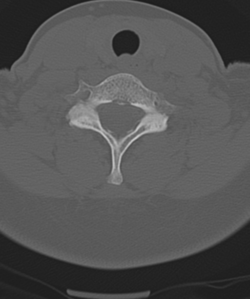 Normal cervical spine MRI (including Dixon) (Radiopaedia 42762-45926 Axial bone window 44).png
