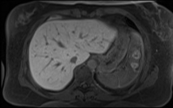 File:Normal hepatobiliary phase liver MRI (Radiopaedia 58968-66230 A 25).jpg