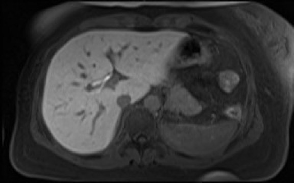 File:Normal hepatobiliary phase liver MRI (Radiopaedia 58968-66230 A 34).jpg