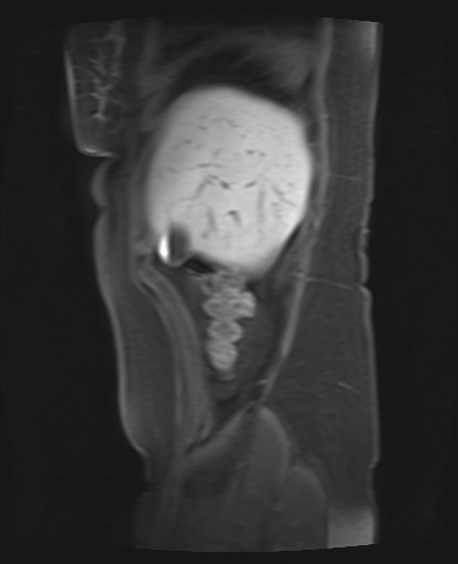 File:Normal hepatobiliary phase liver MRI (Radiopaedia 58968-66230 C 11).jpg