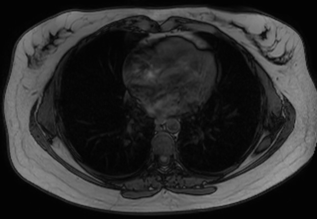 File:Normal liver MRI with Gadolinium (Radiopaedia 58913-66163 B 34).jpg