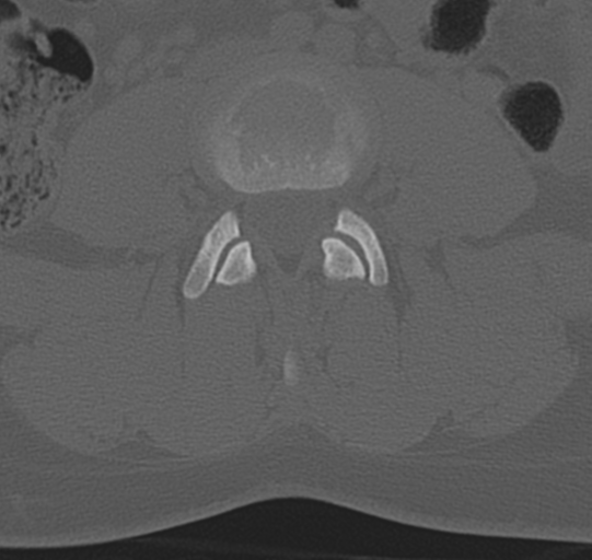 File:Normal lumbar spine CT (Radiopaedia 46533-50986 Axial bone window 43).png