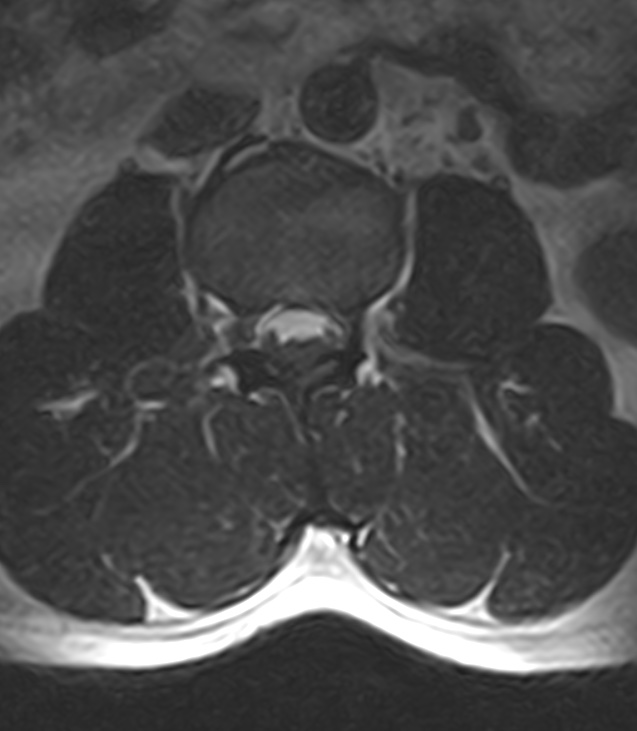 Normal lumbar spine MRI - low-field MRI scanner (Radiopaedia 40976-43699 Axial T2 42).jpg