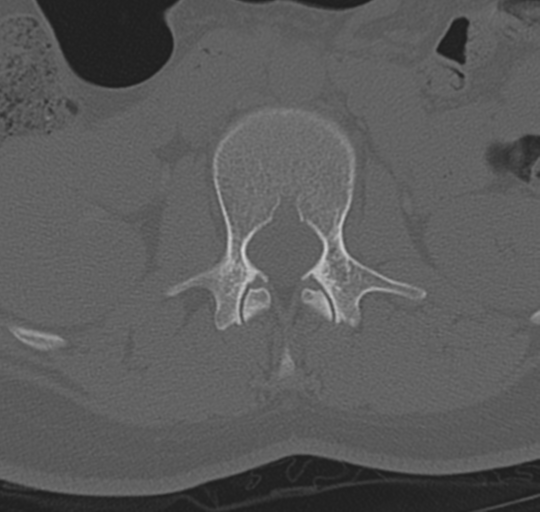 File:Normal lumbosacral CT (Radiopaedia 37923-39867 Axial bone window 40).png