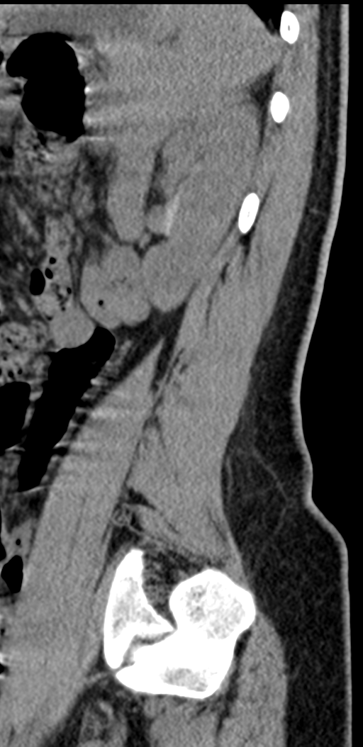 Normal lumbosacral CT (Radiopaedia 37923-39867 E 24).png