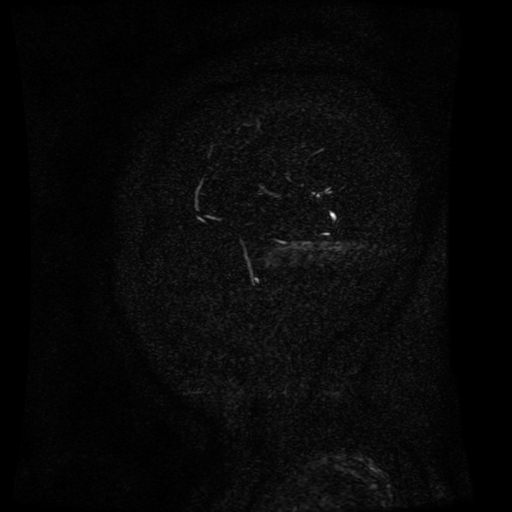 Normal noncontrast MR venography (Radiopaedia 87578-103957 A 164).jpg