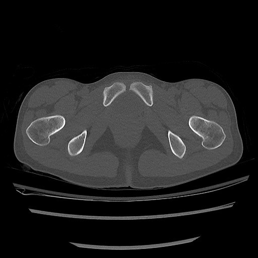 Normal pelvis CT (Radiopaedia 51471-57236 Axial bone window 85).jpg