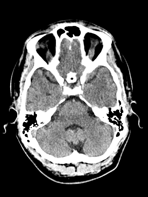 Normal trauma protocol brain and C-spine CT (Radiopaedia 83302-97709 Axial non-contrast 53).jpg